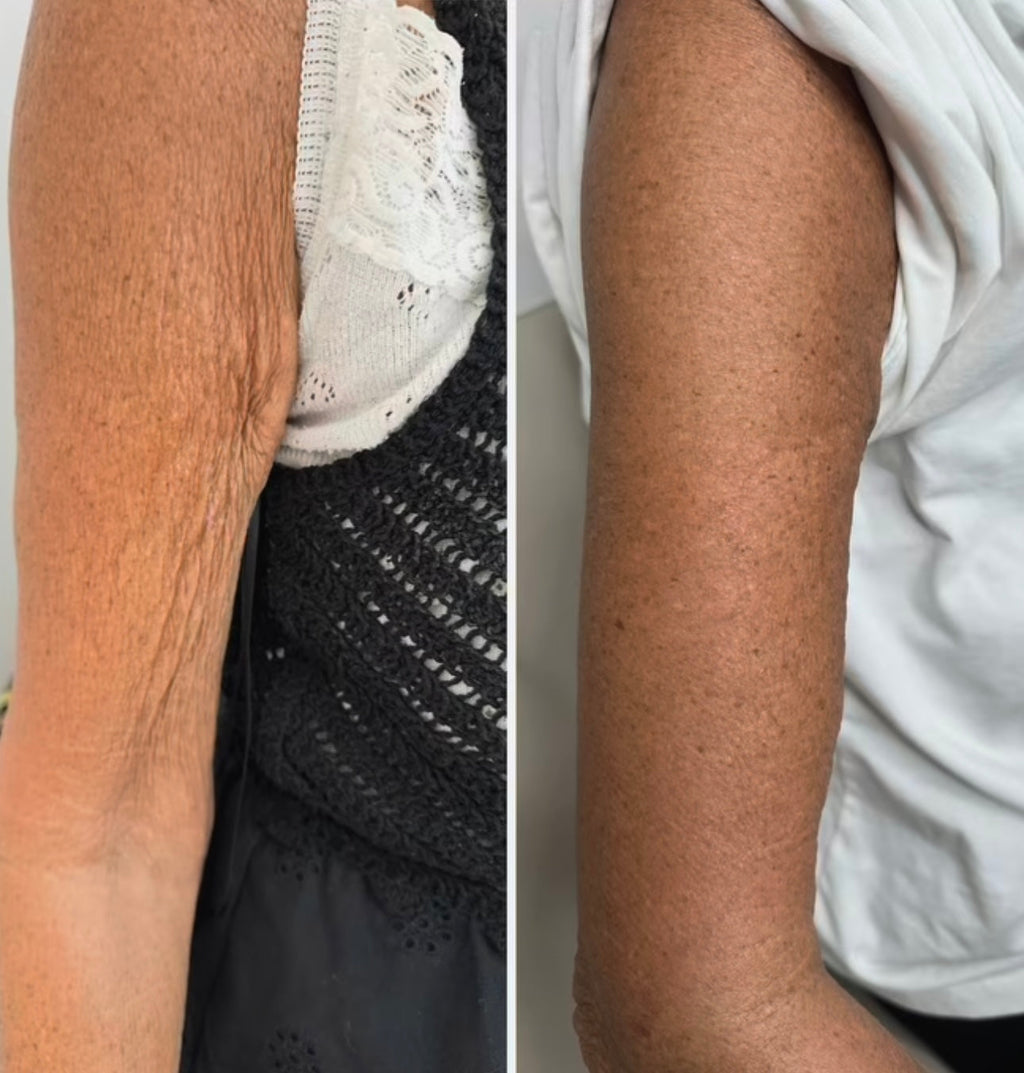 Mesotherapie RH KOLLAGEN   (Hautalterung dramatisch regeneriert, verjüngt)