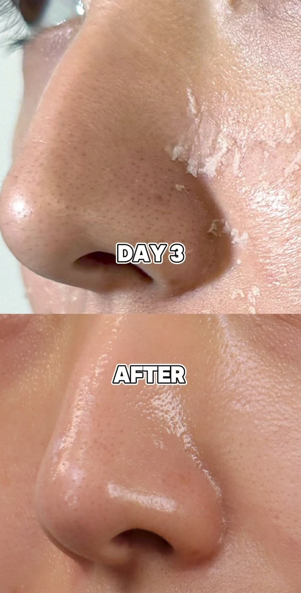 Medisco Peelings S-Deep Peel-Programm + inklusive Heimpflegeprodukten