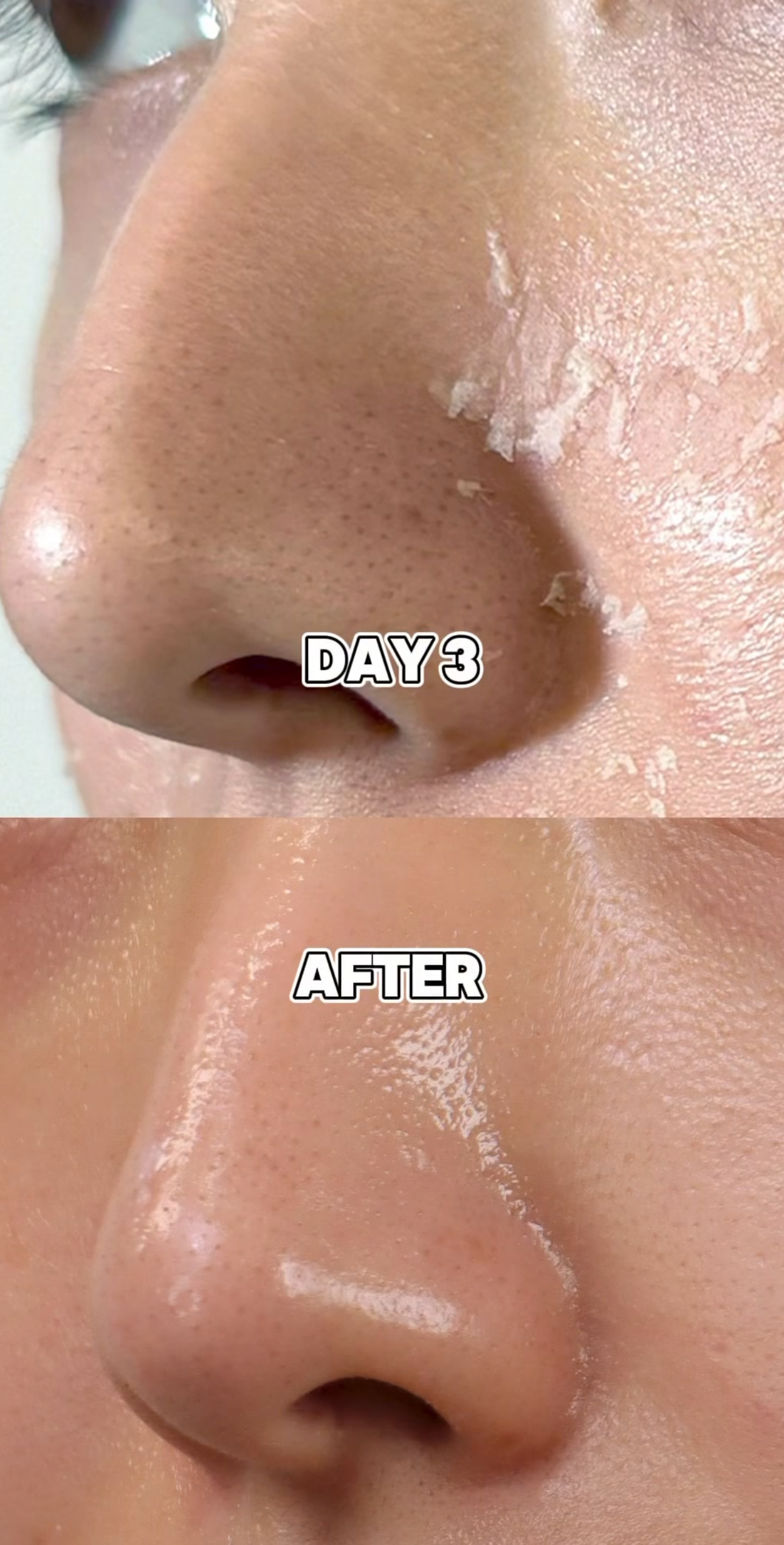 Chemische Peelings S-Light Peel-Programm + inklusive Heimpflegeprodukten
