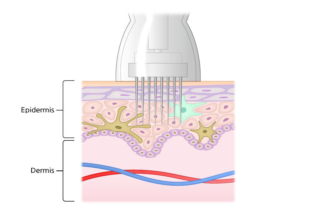 Microneedling Gold + Collagen