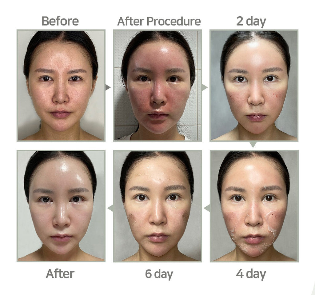 Chemische Peelings S-Light Peel-Programm + inklusive Heimpflegeprodukten