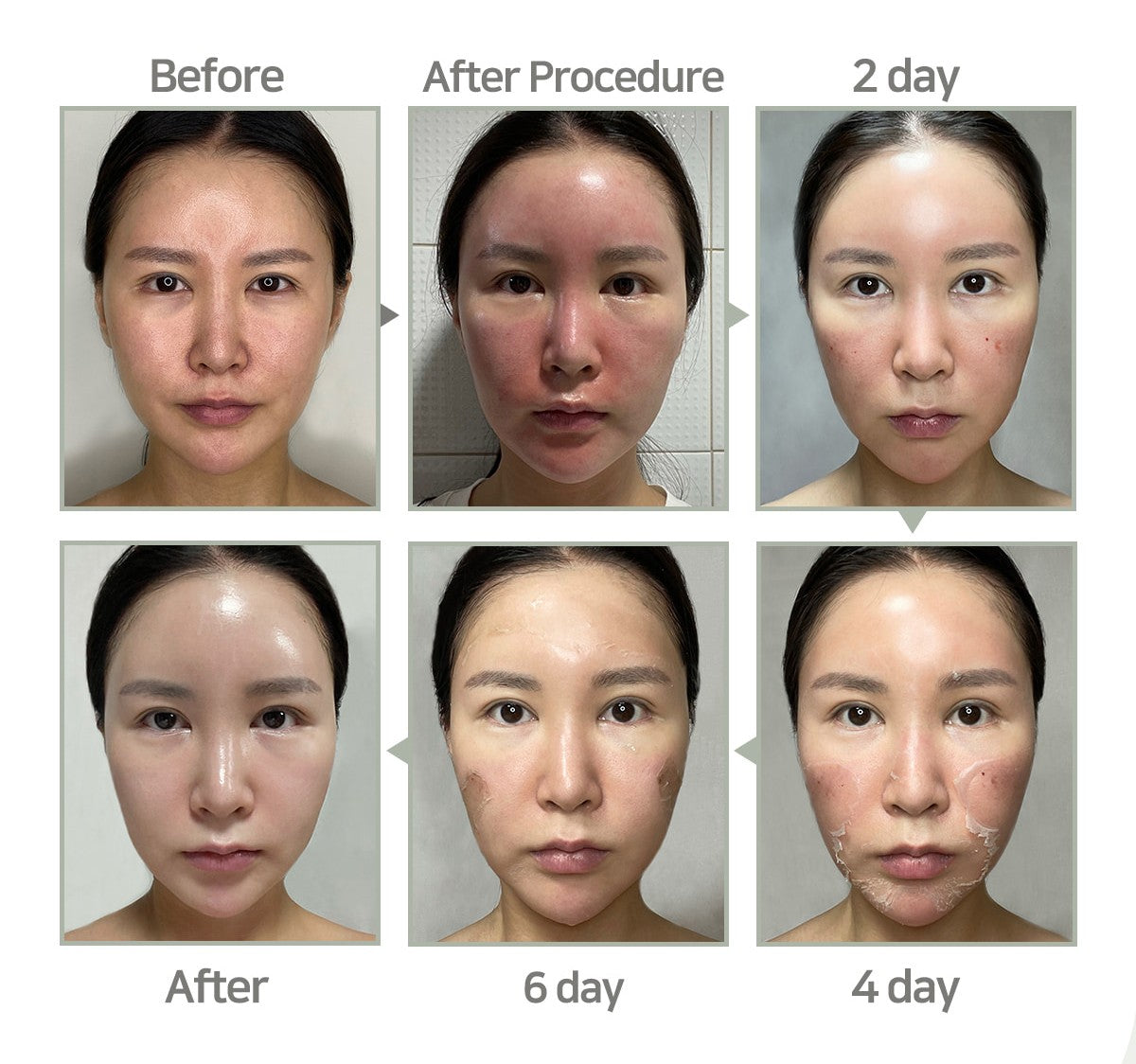 Chemische Peelings S-Light Peel-Programm + inklusive Heimpflegeprodukten