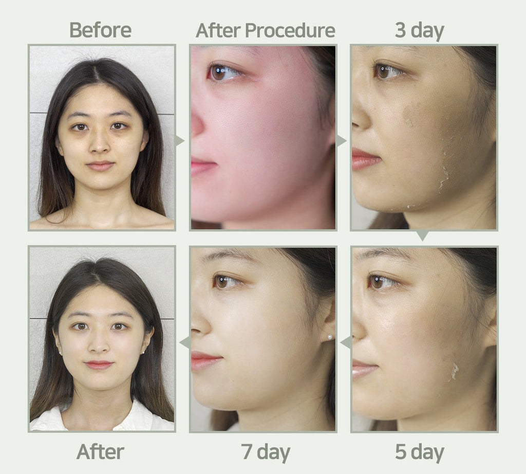 Chemische Peelings S-Light Peel-Programm + inklusive Heimpflegeprodukten